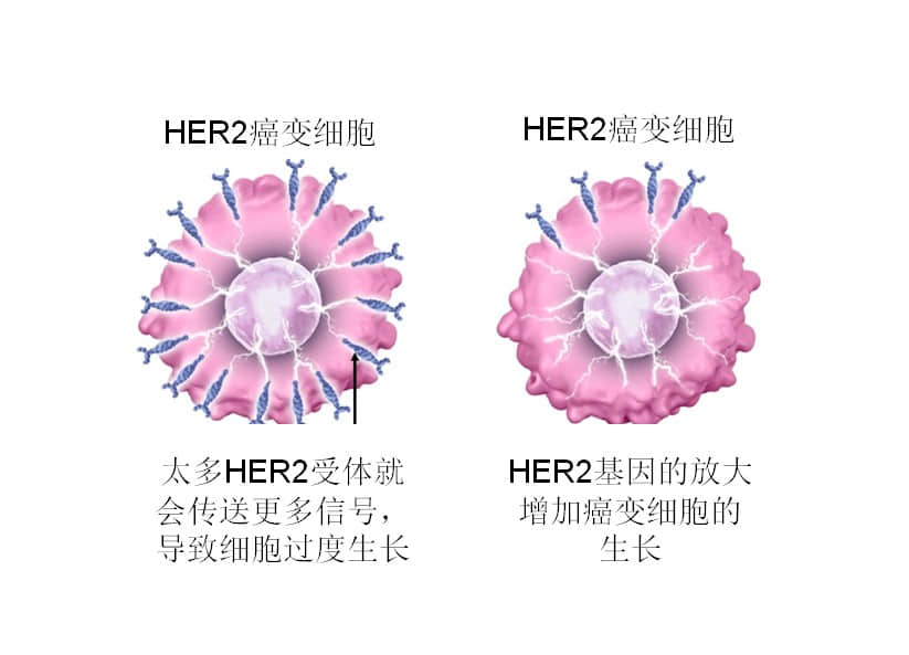 (HER2型乳腺癌为何较为“凶险”?)